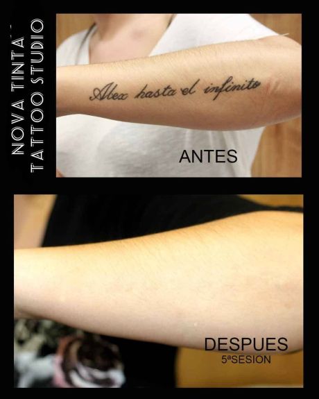 Maquina de borrar tatuajes Nova Tinta Tatoo